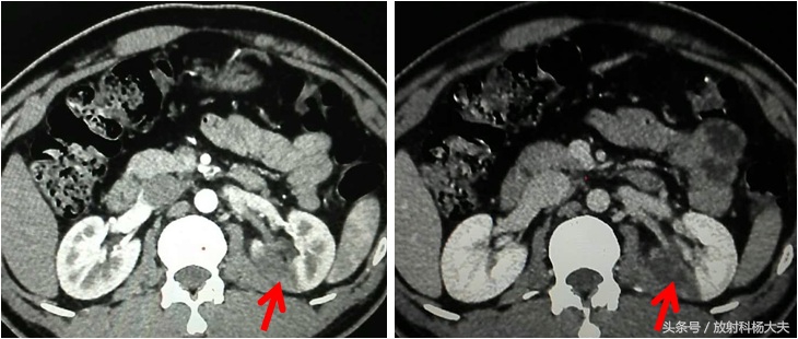 外科医生腰痛，自己诊断为结石，三天后做CT，却是肾梗死