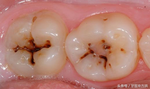 蛀牙从小洞发展到大洞多长时间,牙齿从有蛀牙到完全坏要多长时间