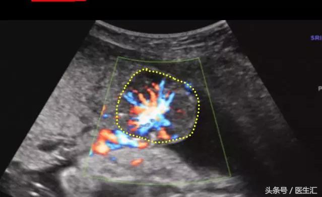 胎盘早剥病例课件,胎盘早剥的超声鉴别诊断