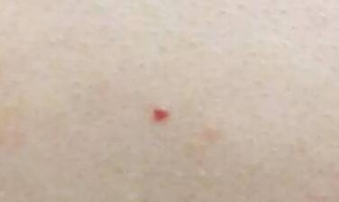 红痣的出现民间意味着什么,突然冒出来的红色痣怎么处理