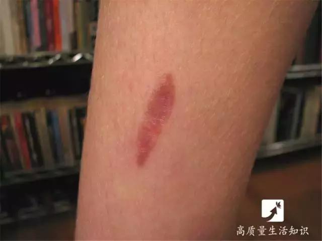 大人被开水烫伤怎么处理好得快,开水烫伤急救知识