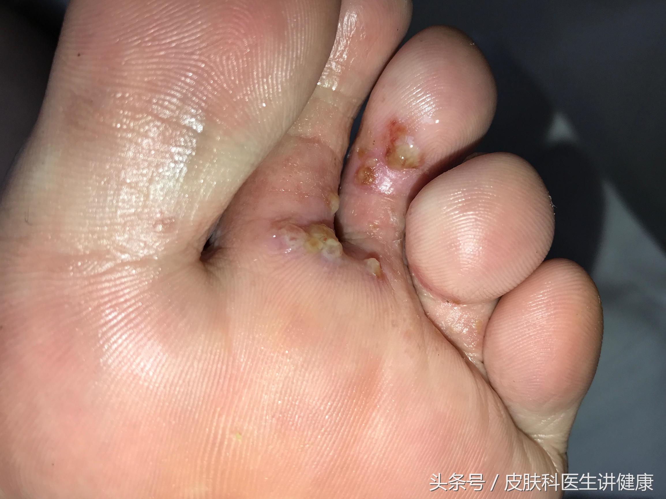 手上很多小水泡是汗疱疹?医生:不是,这是脚气导致的!