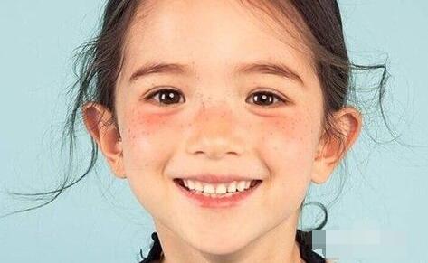 鼻梁两侧黑色素像斑怎么回事,鼻梁黑色素沉淀有什么偏方去除