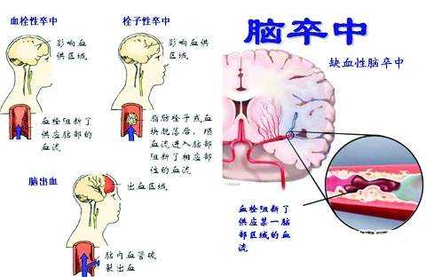 脑梗塞、脑血栓、脑出血不同时期怎么治疗