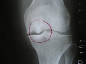 骨刺其实不是病别再被忽悠了,骨刺有多可怕视频