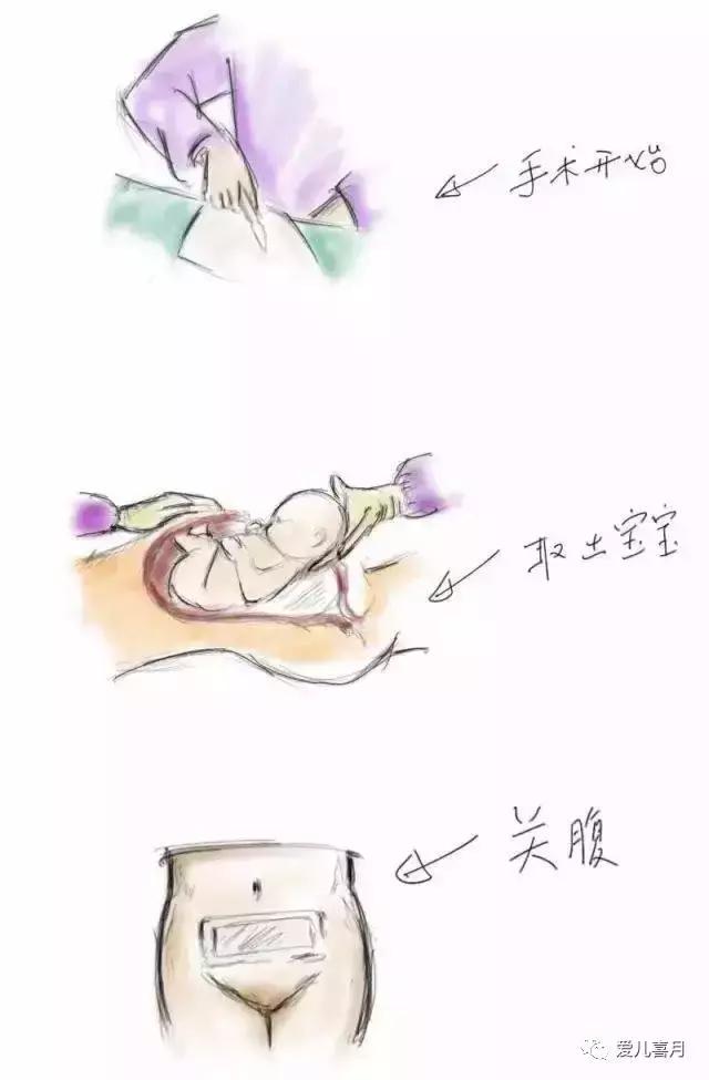 如何画剖腹产,什么是剖腹产手绘画