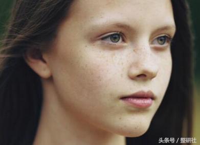 光电祛痘坑效果,光电祛斑拯救麻子脸