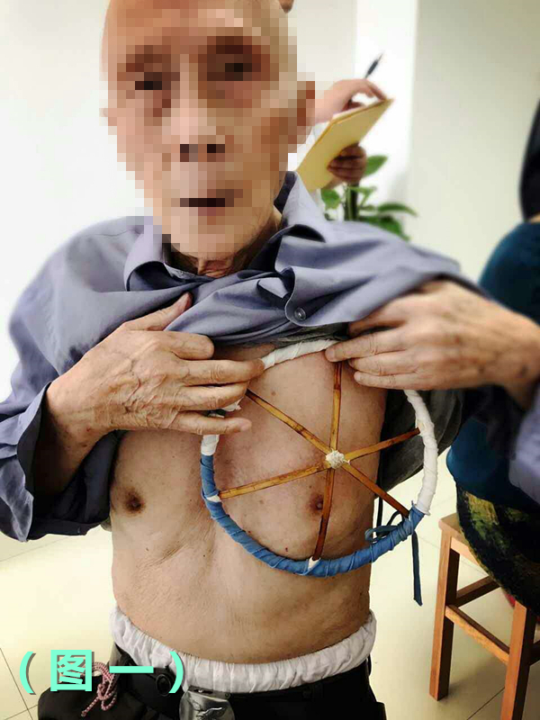 带状疱疹后遗神经痛针灸,带状疱疹后遗神经痛贴膏