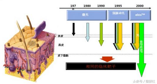 光电祛痘坑效果,光电祛斑拯救麻子脸