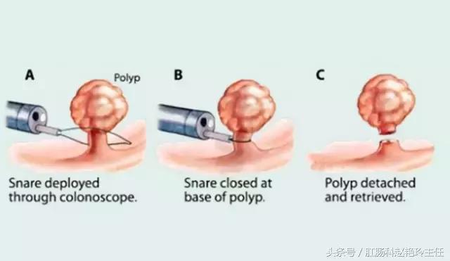 无痛肠镜检查的亲身经历,无痛肠镜真的一点都感觉不到吗