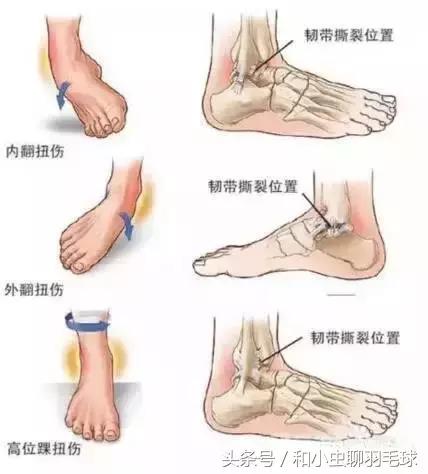 打羽毛球脚踝扭伤会骨折吗,预防脚踝扭伤羽毛球训练方法