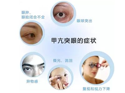 “甲亢”治疗成“甲减”是成功治疗甲亢的标准？