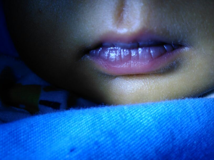 血稠的原因和症状和解决方法,血稠一定要重视