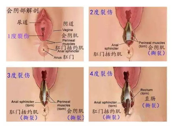 顺产时,自然撕裂、侧切哪个恢复快?有什么区别和影响