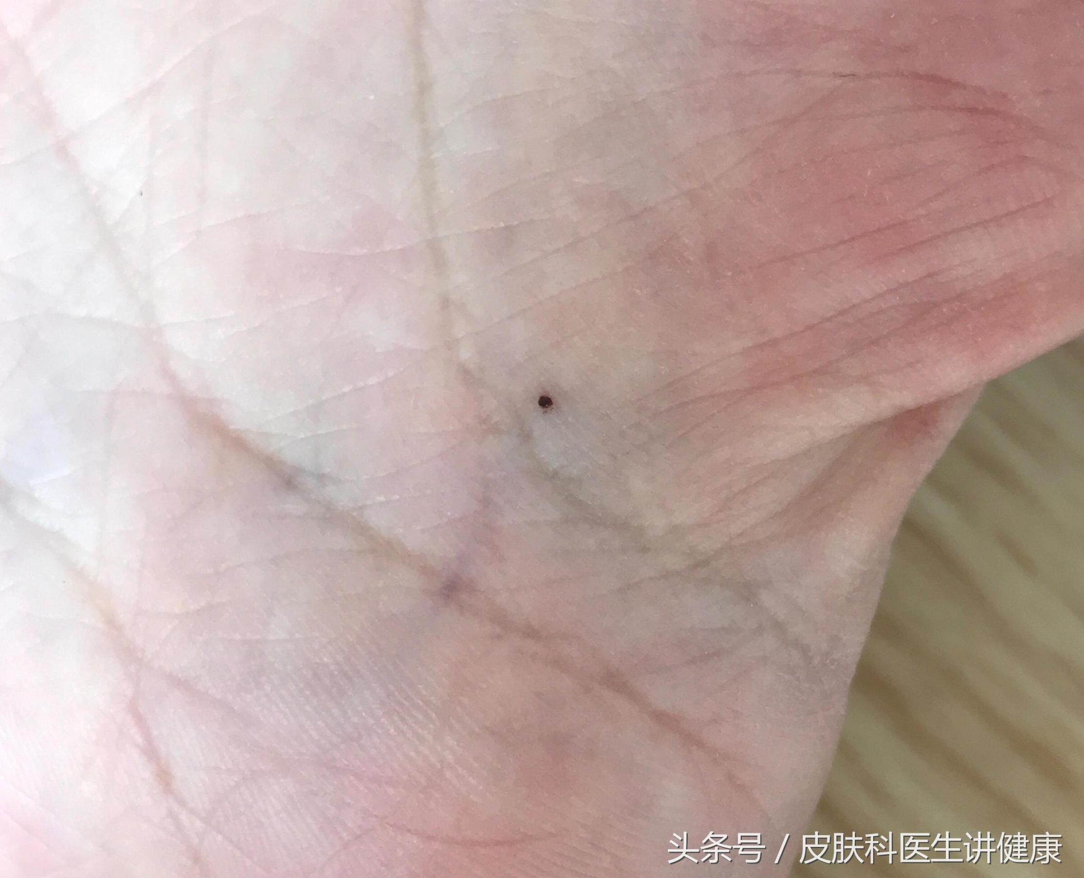 超过30岁脸上的斑点越来越多,突然长出来的色素痣会自行消退吗