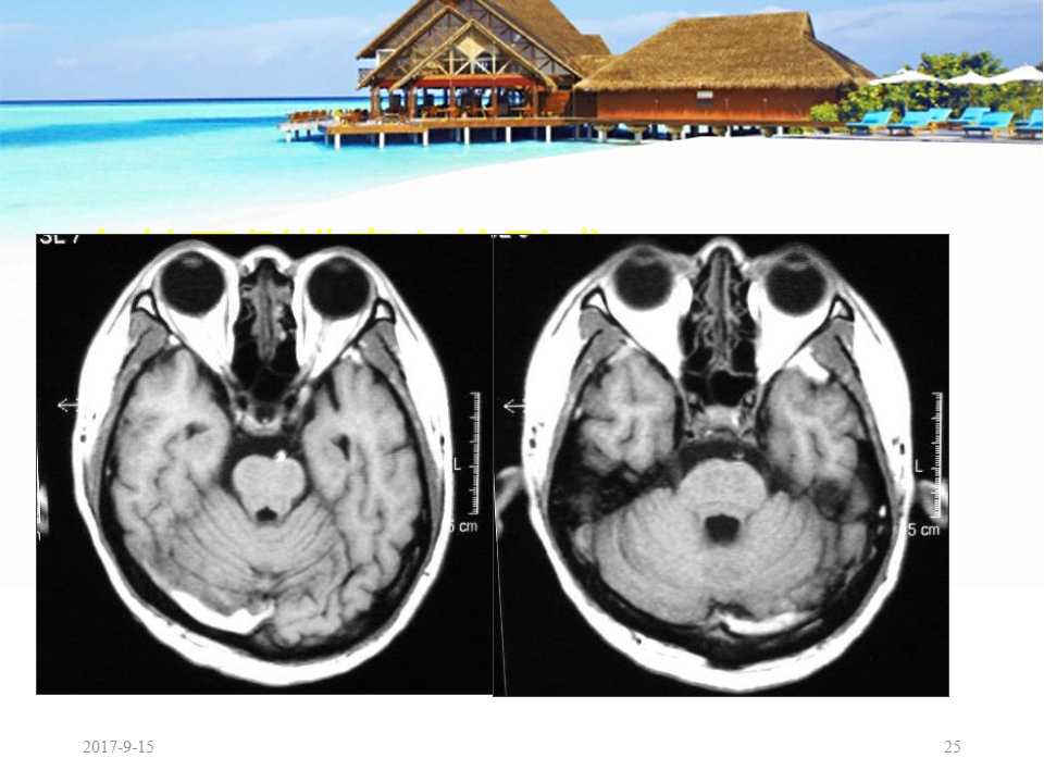 颅内静脉窦血栓形成怎么治疗,颅内静脉窦血栓怎么治疗