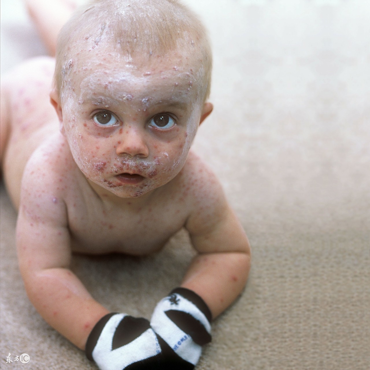 妈妈得了水痘宝宝怎么预防,大人护理儿童水痘的防范措施