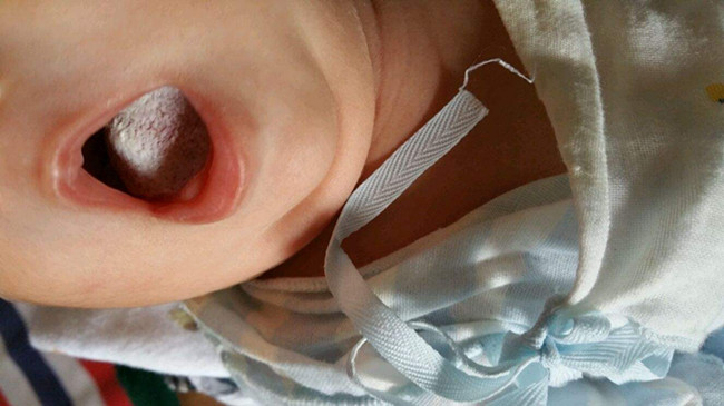 宝宝有了鹅口疮怎么办？在济南试试这种办法吧