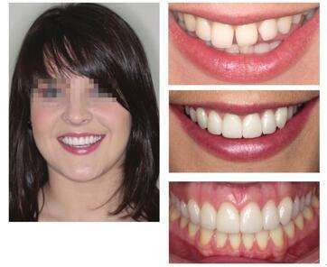 牙齿有缝能用牙套矫正吗,牙齿有缝可以补吗