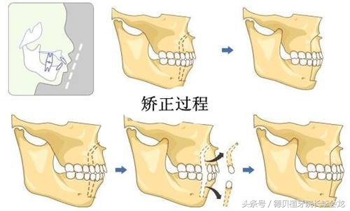 箍牙过程中有牙缝正常吗,箍牙的过程疼吗