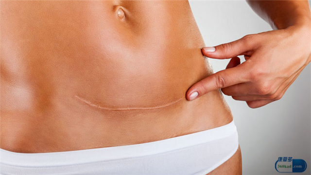 产后愈合不良不处理会怎样,产后伤口没长好是什么样的