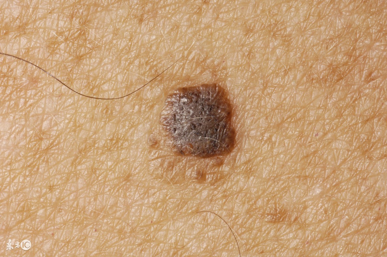 美容科医生汤爱荣：年轻人防止老年斑，这8招管用！