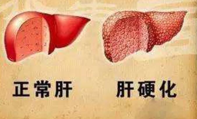 皮肤出现蜘蛛痣是不是肝硬化,皮肤出现蜘蛛