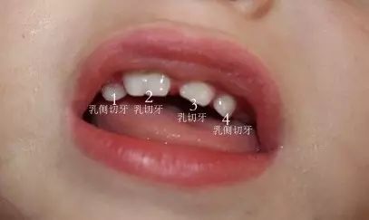 双牙重叠,连着两颗牙齿松动怎么办