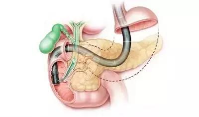 如何能远离“癌中之王”