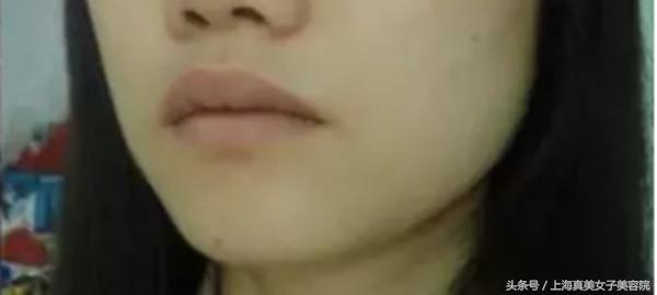 下巴和嘴周围经常冒痘？有对策！