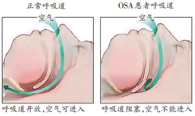 戴上耳机听呼噜声睡觉,戴上耳塞能听到呼噜声