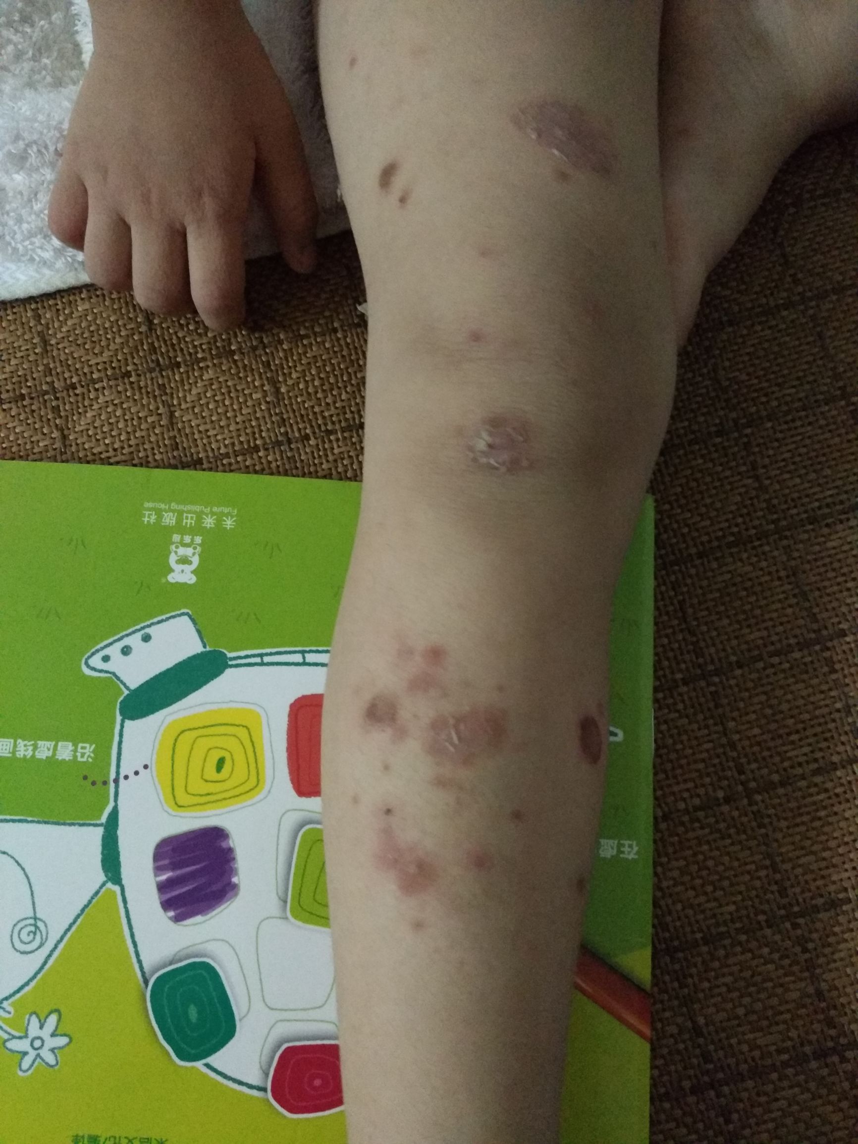 孩子在幼儿园被传染上虱子怎么办,小孩被传染疮了怎么办