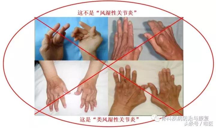 受寒骨关节炎,关节疼类风湿关节炎医学知识科普