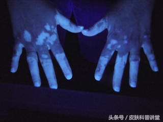 白癜风最新治疗方法录音,白癜风的治疗新进展