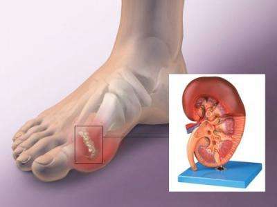 痛风居然还会引发尿毒症?医生告诉你三种方法治疗痛风!