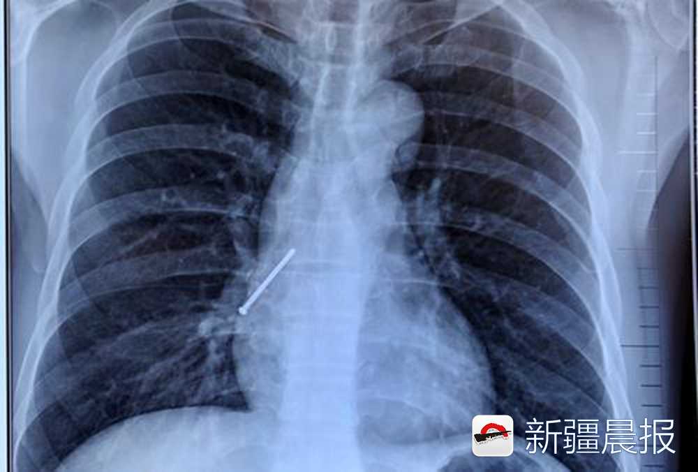 乌市一装修工口含铆钉作业张口说话4厘米长钉子滑进气管入肺