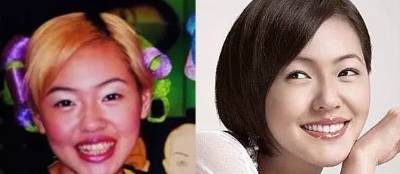 网上买透明牙套矫正牙齿靠谱吗,小孩矫正牙齿用哪种牙套比较好