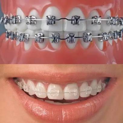 网上买透明牙套矫正牙齿靠谱吗,小孩矫正牙齿用哪种牙套比较好