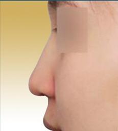 微整是怎么做到无痕的,微整怎么辨别