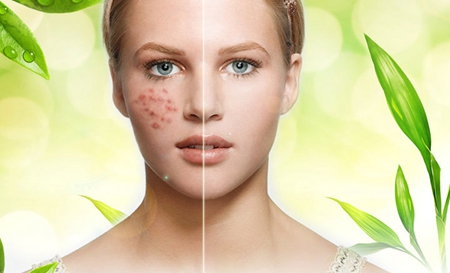 油性皮肤如何去痘痘这些方法你值得一试