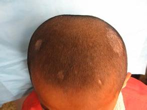 对于真菌感染的皮肤病怎么治,真菌感染皮肤问题的克星