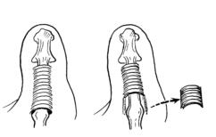手指腱鞘炎怎么治,膏药能治腱鞘炎吗