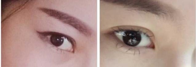 内双眼皮怎么变外双费用多少,眼皮一个内双一个外双怎么矫正