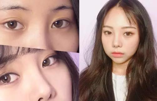 眼角鼻梁塌怎么拯救,鼻梁塌陷怎么补救不手术