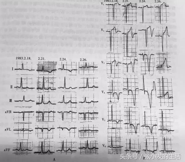 心绞痛与急性心肌梗死的鉴别,不稳定型心绞痛和急性心肌梗死