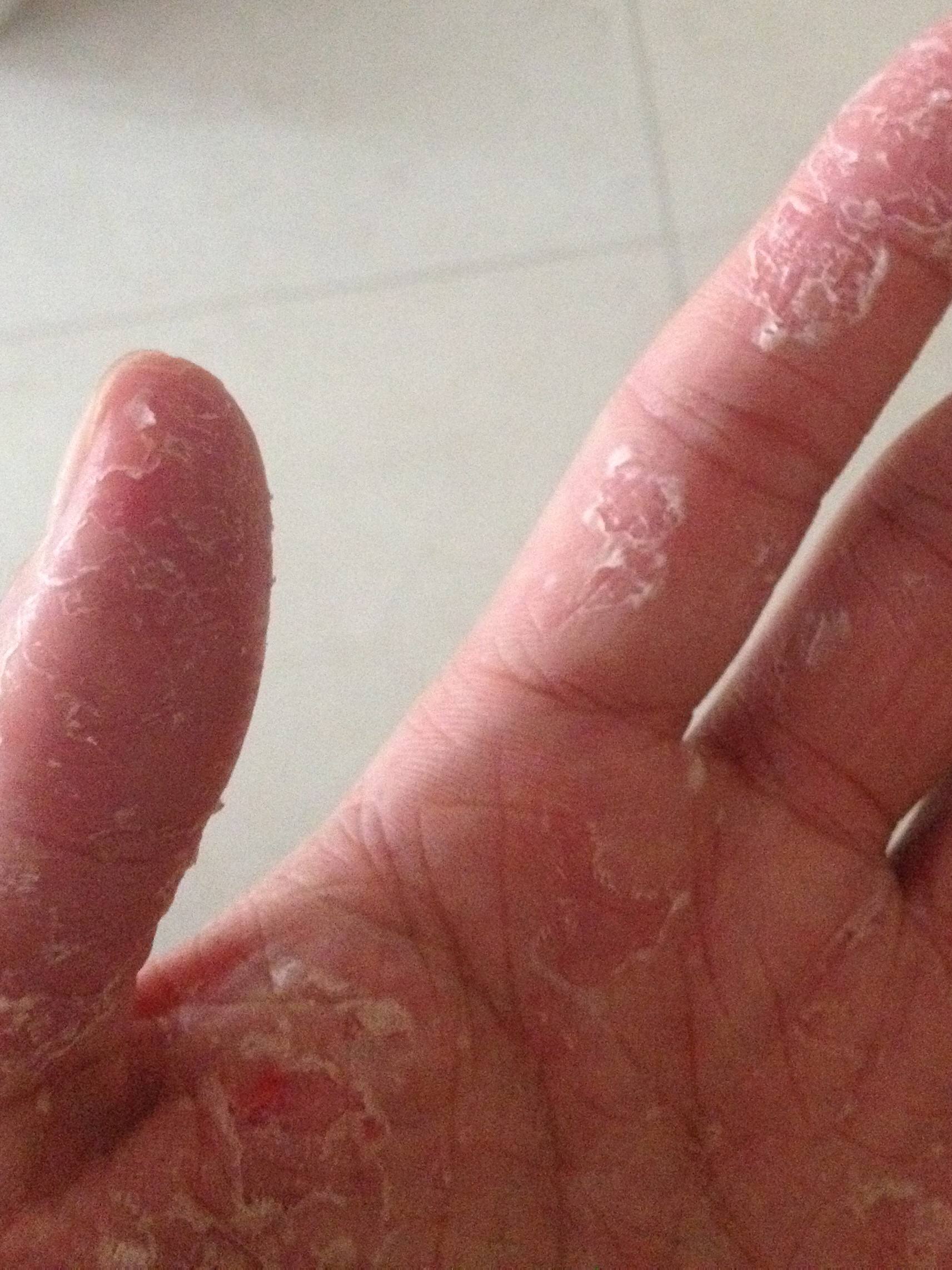 手掌癣脱皮干裂,双手对称蜕皮裂口是不是手癣