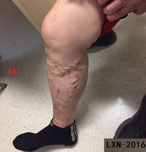 针刺放血疗法能治哪些病,放血疗法治疗腰间盘突出症