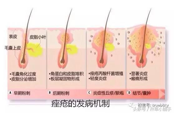 用1000块买遮瑕粉底液，都不如这些100元的祛痘神器