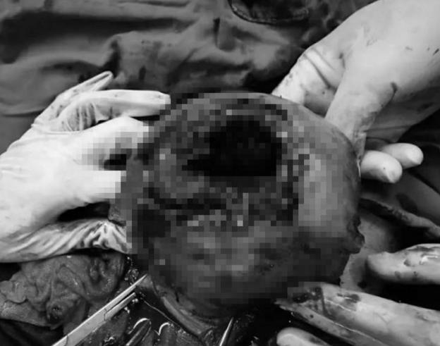 胎儿踢破子宫卡在妈妈肚子里,胎儿一脚踢破子宫怎么回事