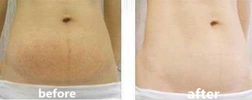 深扒“网红”神油,8周改善妊娠纹和疤痕~